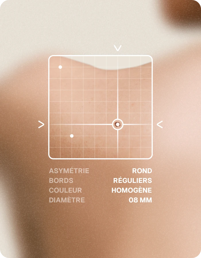 analyse d'une lésion