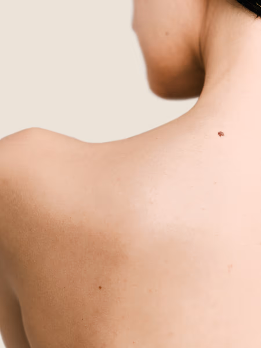 Vue rapprochée du dos et du cou d'une personne avec un grain de beauté visible sur la peau claire.
