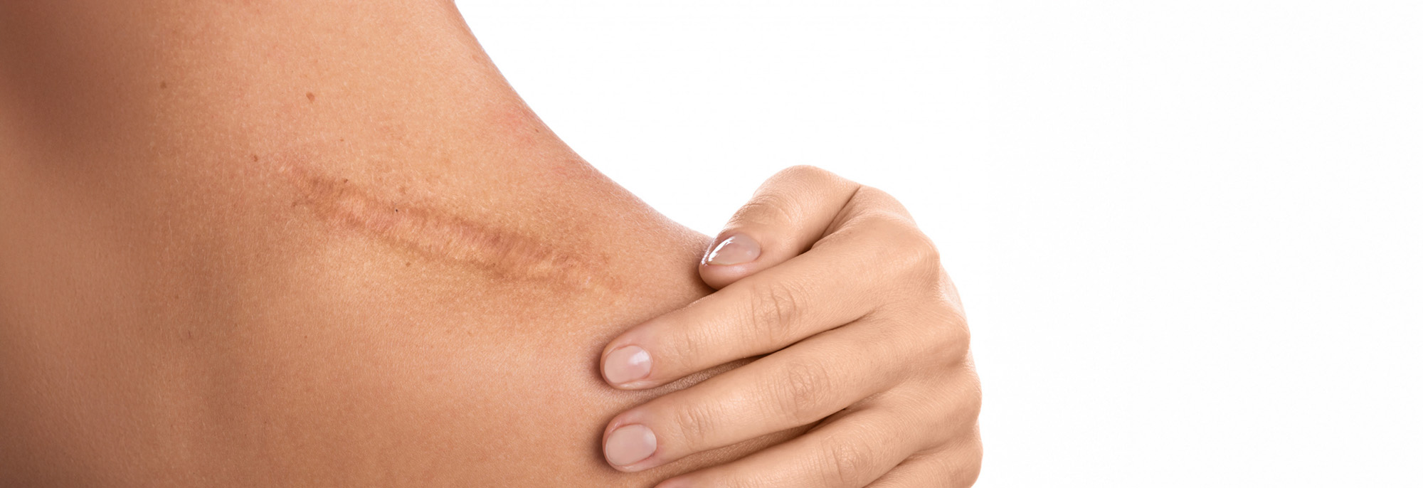 Zbliżenie na ramię osoby z widoczną blizną i dłoń delikatnie ją dotykającą.