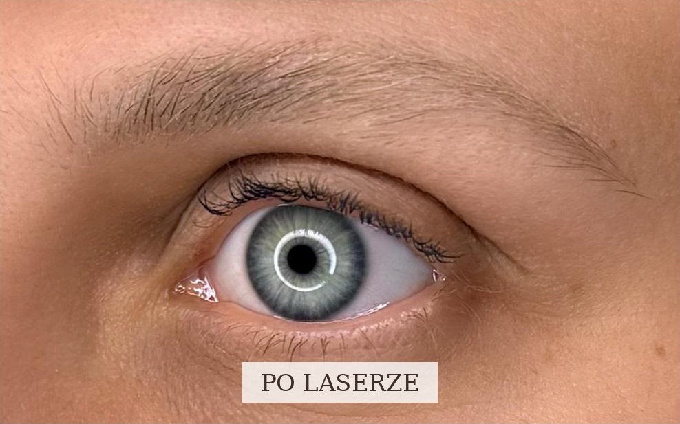 Te same brwi po zabiegu laserowym: pozostały pigment zmienił kolor z ciepłej czerwieni w chłodną, jasną szarość