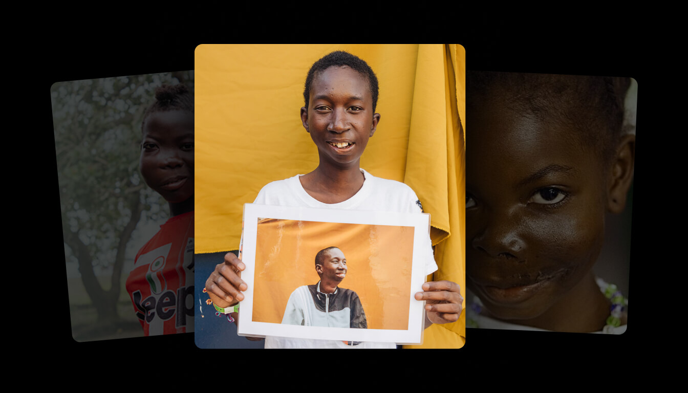 As a child, Modou developed a condition called ankylosis, which made it difficult for him to speak and eat. This condition left Modou severely malnourished, and by the time he was 20 years old, he weighed only 68 pounds.