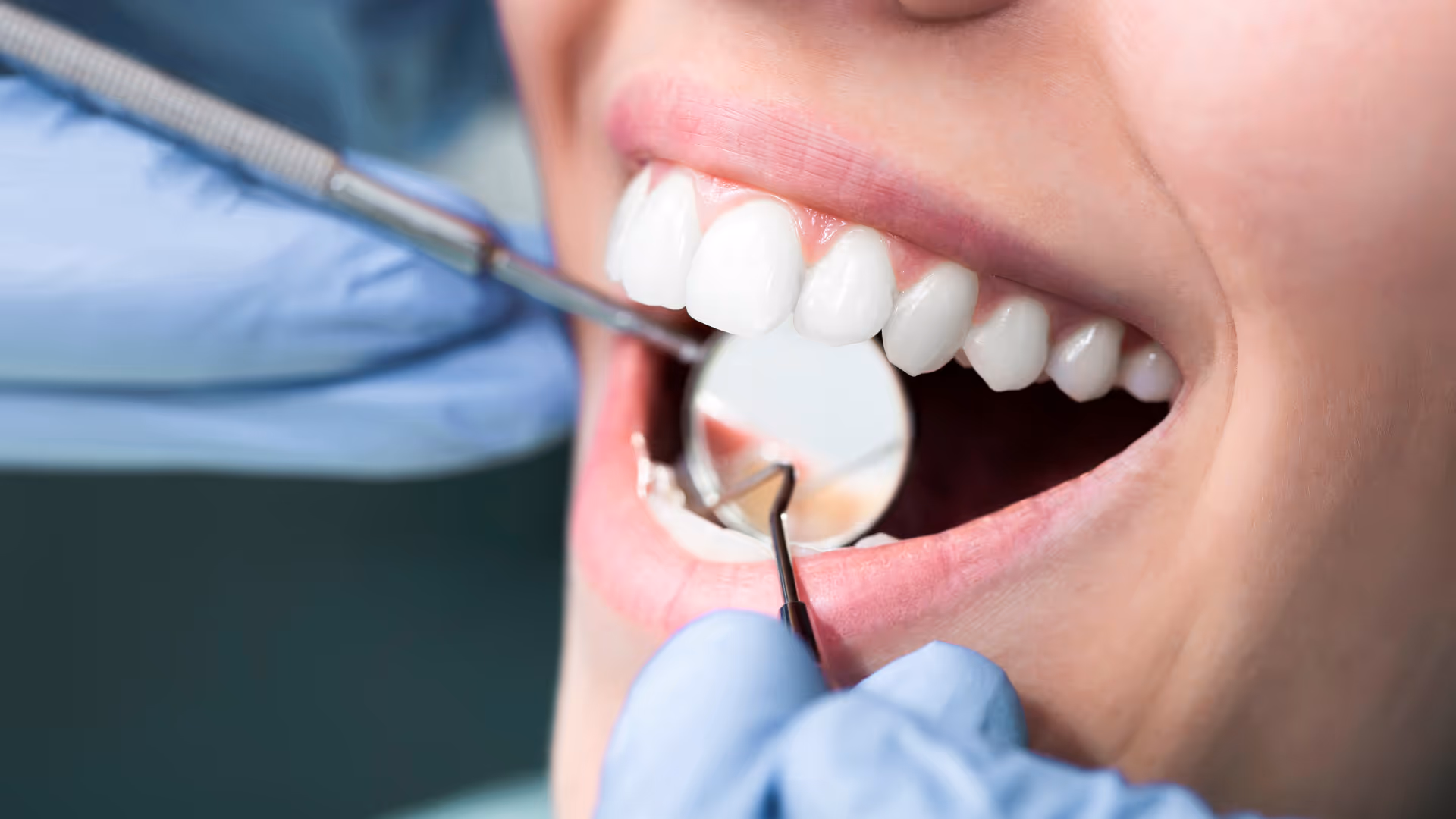 Close-up of a dental examination showing a patient's open mouth with a dental mirror and probe held by gloved hands.