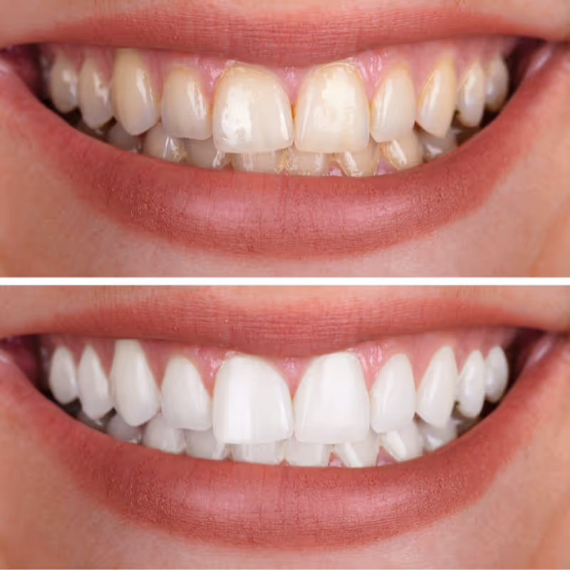 Close-up comparison of a person's smile showing teeth before and after whitening treatment, with yellowed teeth on top and bright white teeth below.