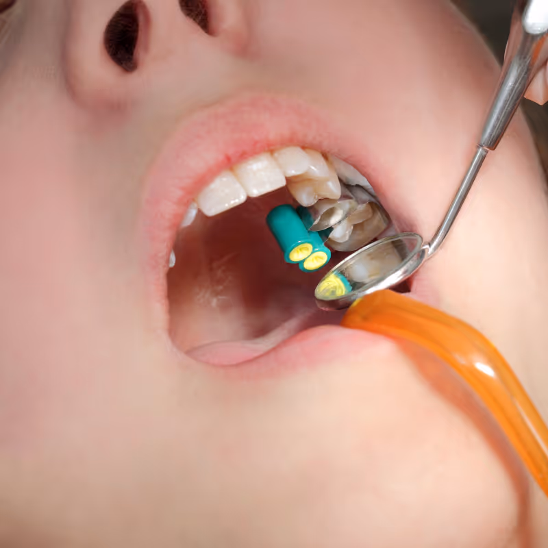 Close-up of a person’s open mouth showing dental tools inspecting teeth with green rubber dam clamps.
