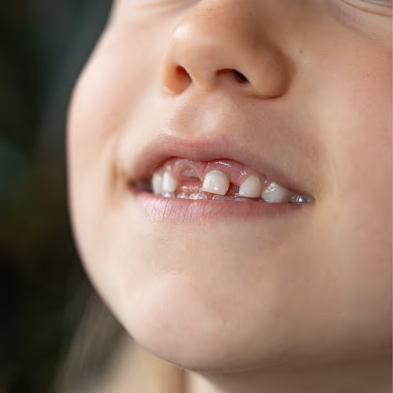Close-up of a child's mouth showing baby teeth with a gap where a tooth is missing.