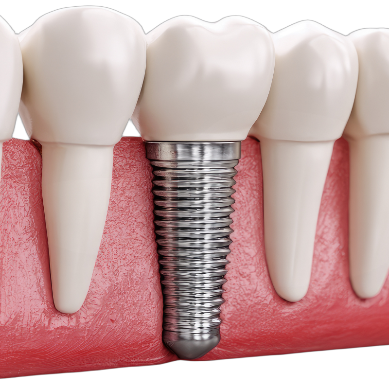 Close-up of a dental implant with a metal screw inserted into the gums, surrounded by natural teeth.