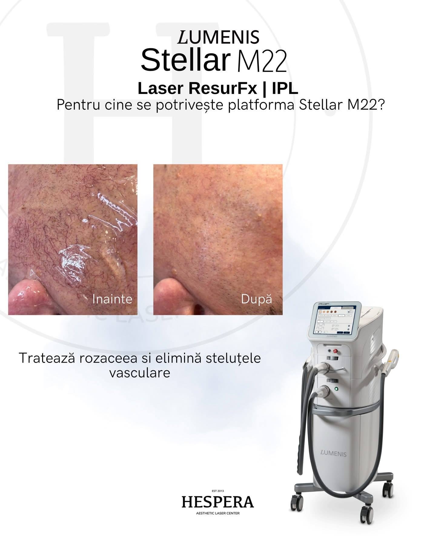 Tratamentele IPL pentru un ten sanatos