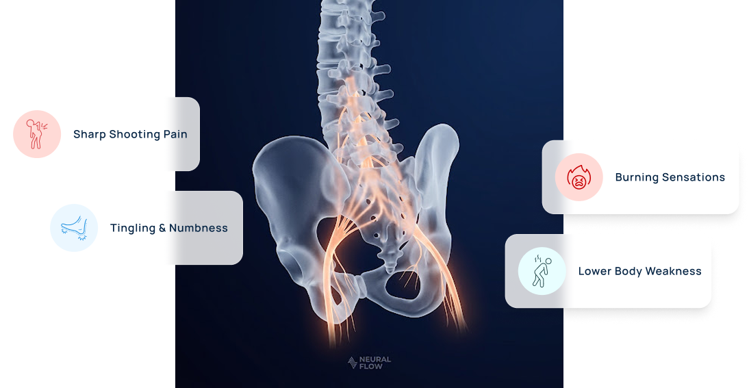 Anatomical diagram of the spine and sciatic nerve with common symptoms