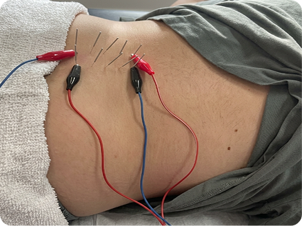 Dry needling treatment in progress