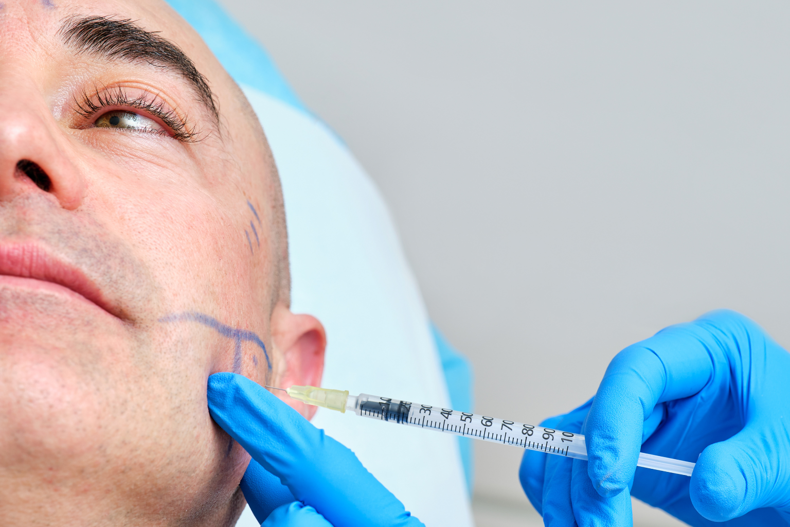 Masseter Botox for Teeth Grinding (Bruxism): A Non-Surgical Solution