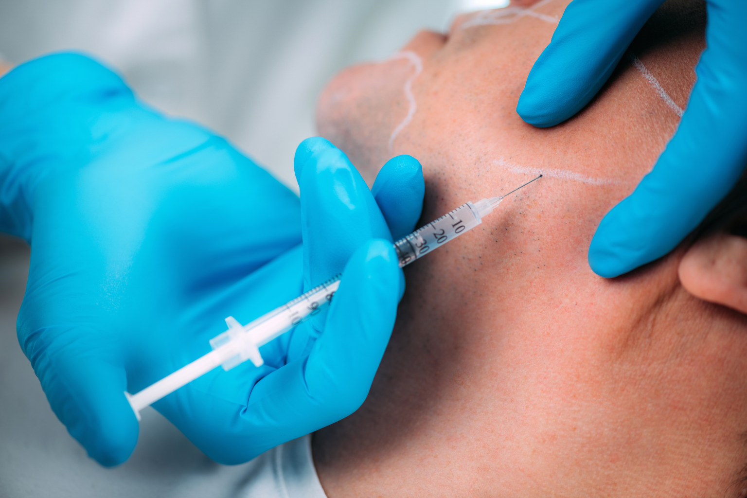 Jawline Slimming with Botox: Realistic Results and How Many Units You Need