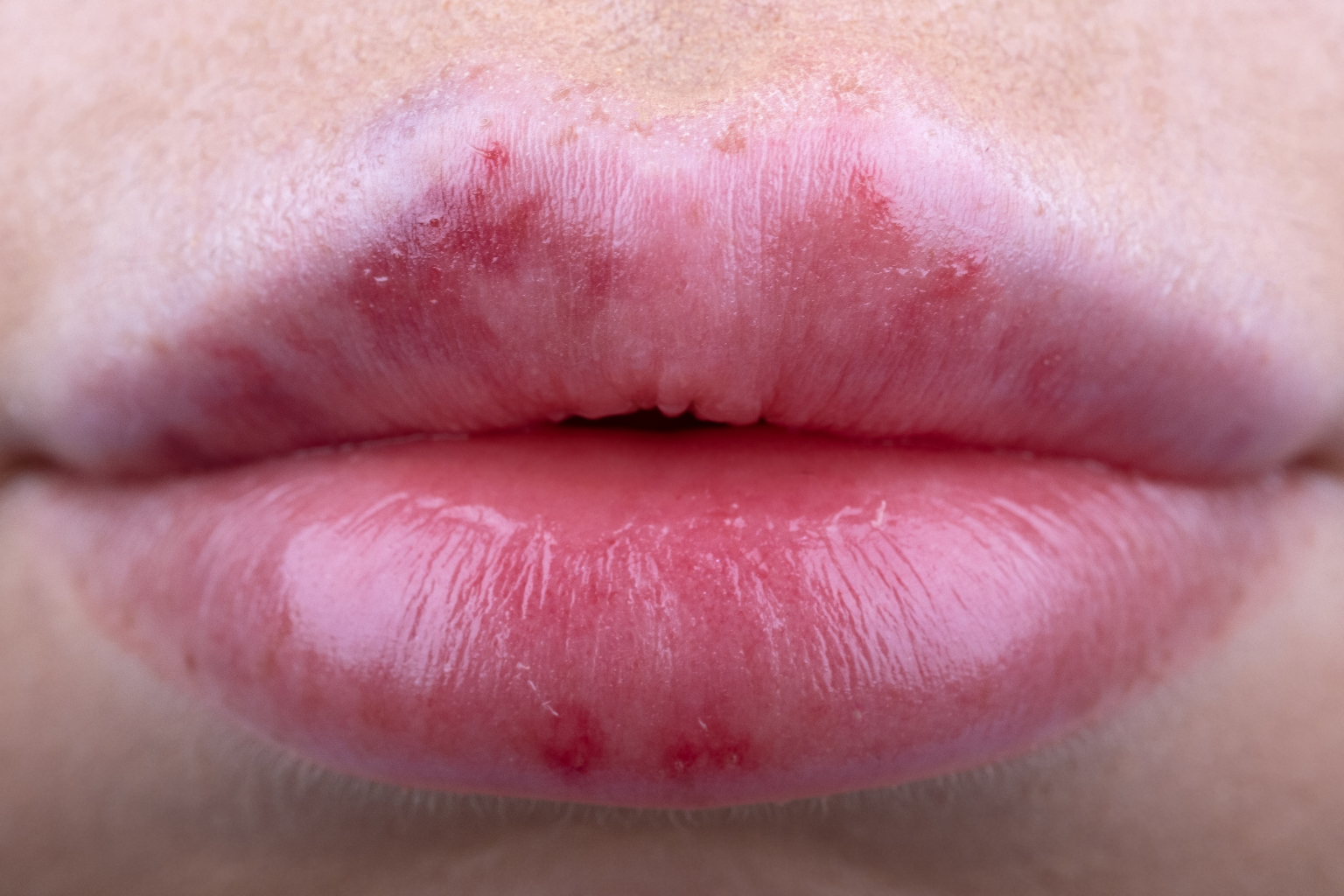 How to Reduce Bruising After Lip Filler