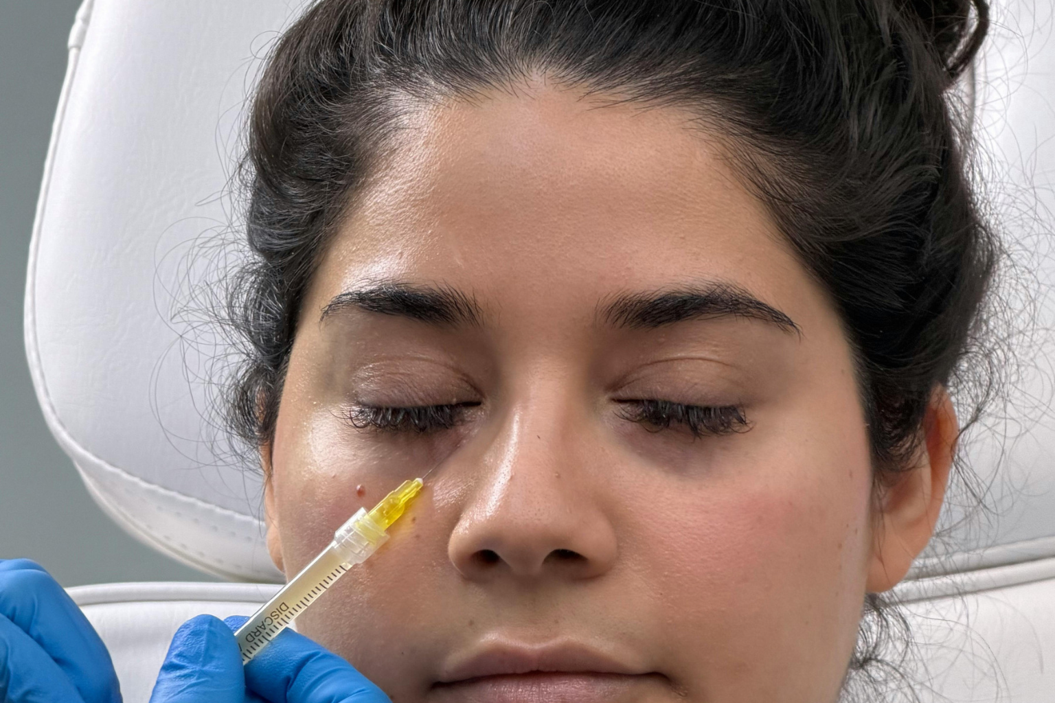 Tear Trough Filler: Treating Hollow Under-Eyes and Dark Circles