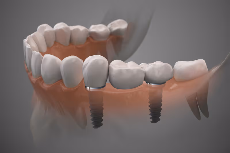 Proper Oral Hygiene for Dental Implants