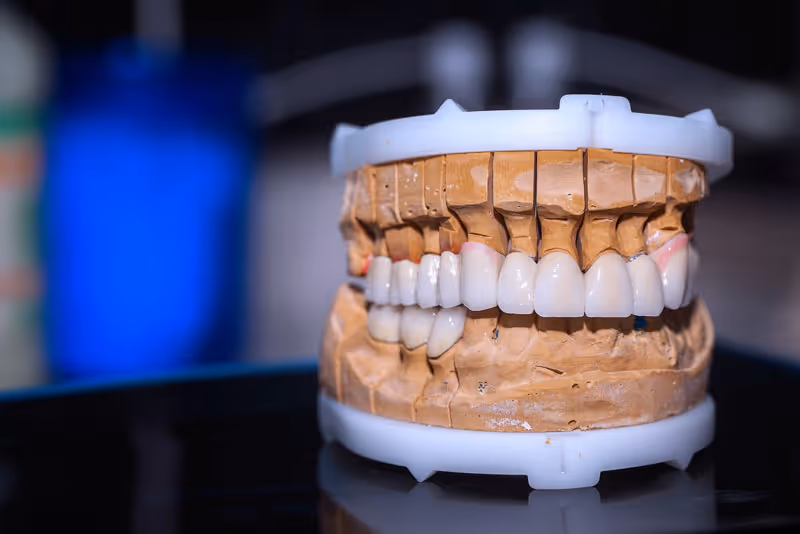 Am I Able To Have A Full Arch Of Missing Or Damaged Teeth Replaced?