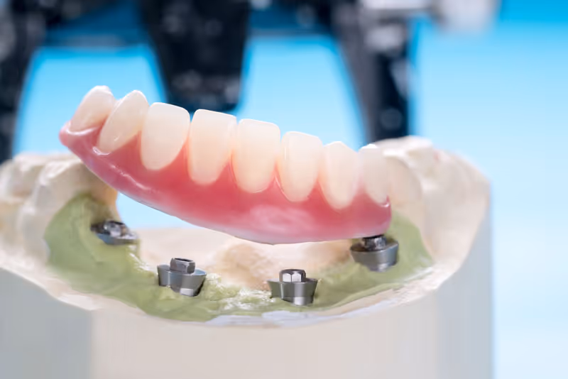 Will My Smile Be Stable And Comfortable With Implant Supported Dentures?
