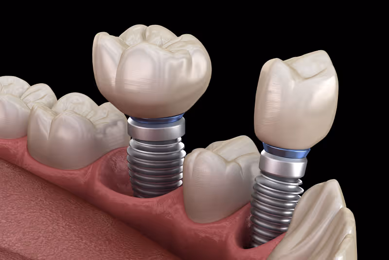 Are There Aesthetic And Functional Benefits To Getting Treated With Multiple Dental Implants?