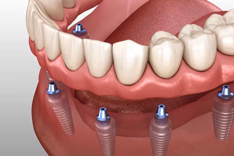 Will Implant Supported Dentures Give Me A More Stable Smile Than Traditional Dentures?