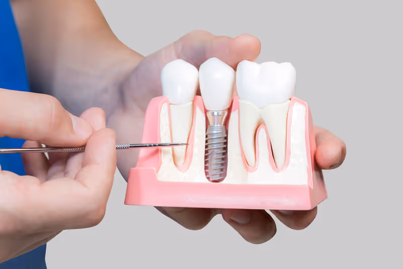 Are There Specific Parts That Make Up A Dental Implant?