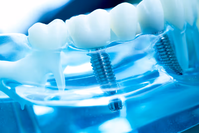 Can Dental Implants Give Me A Permanent New Smile?