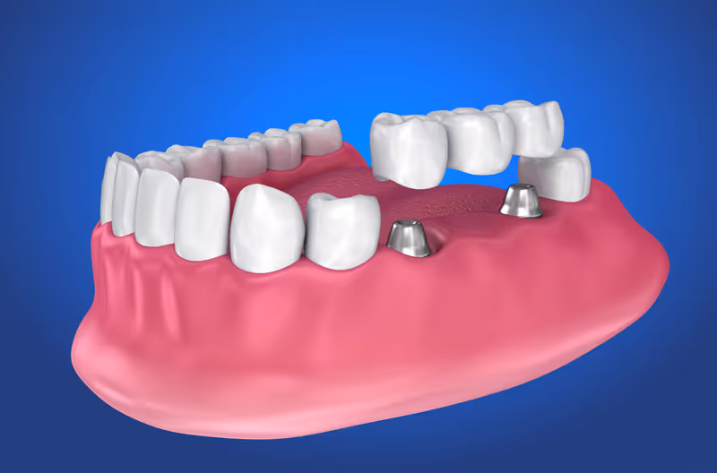 Am I A Candidate For Implant Supported Dentures?