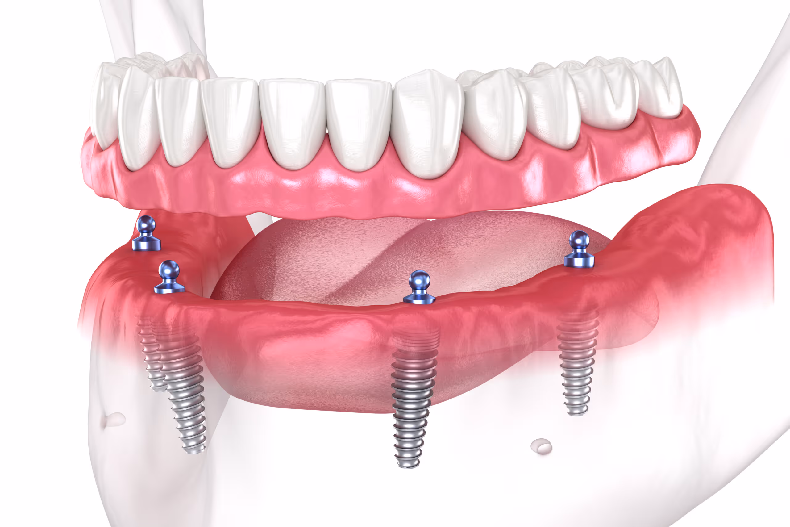 Am I Going To Benefit From Getting Treated With Full Mouth Dental Implants In Missoula, MT?
