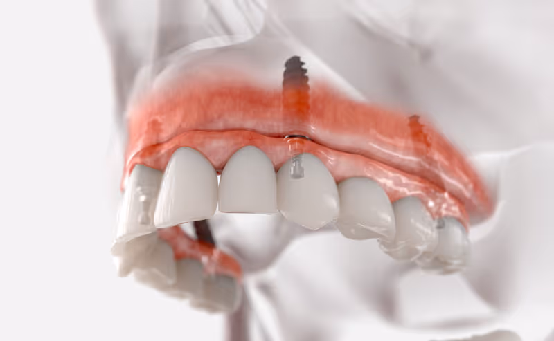 The Path to Smile Restoration: Secrets of Implants of Teeth