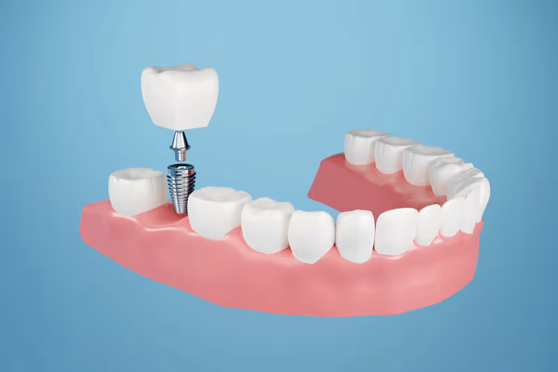 Uncovering the Mystery: The In-depth Guide to Dental Implants