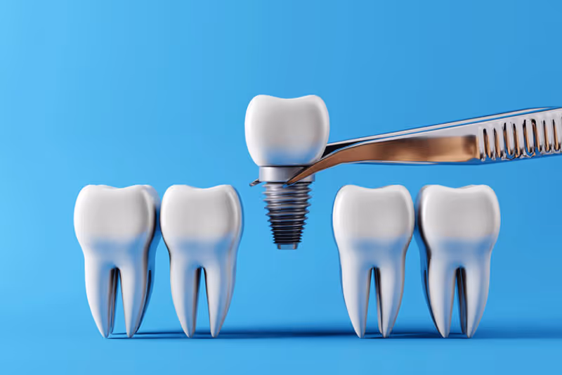 Your Comprehensive Guide on Dental Implants: The Best Replacement of Tooth Solution