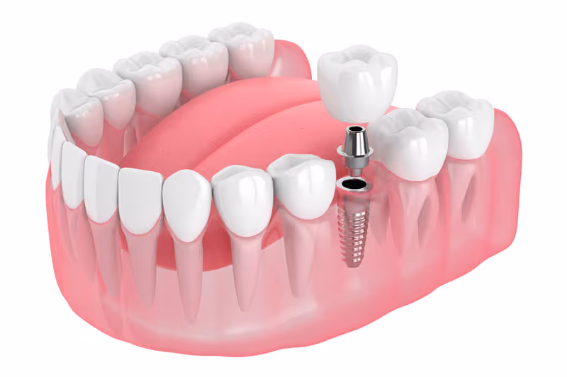 Securing Smiles in The Garden City: Understanding Dental Implants in Missoula, MT