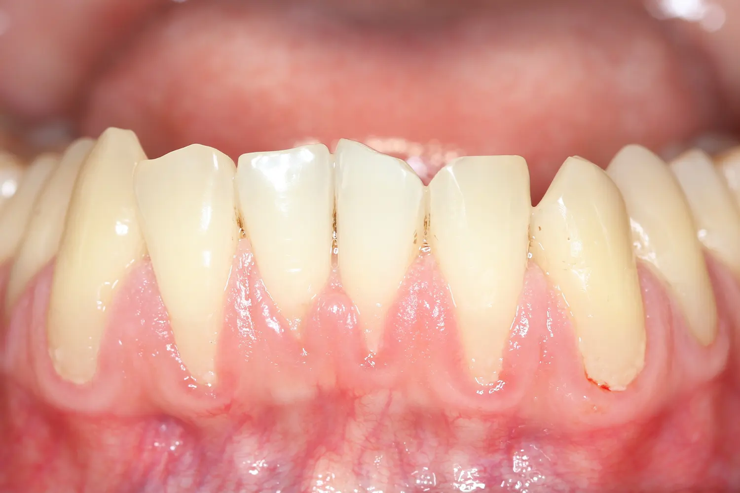 Why Do Your Gums Recede Over Time (And How to Slow It Down)?