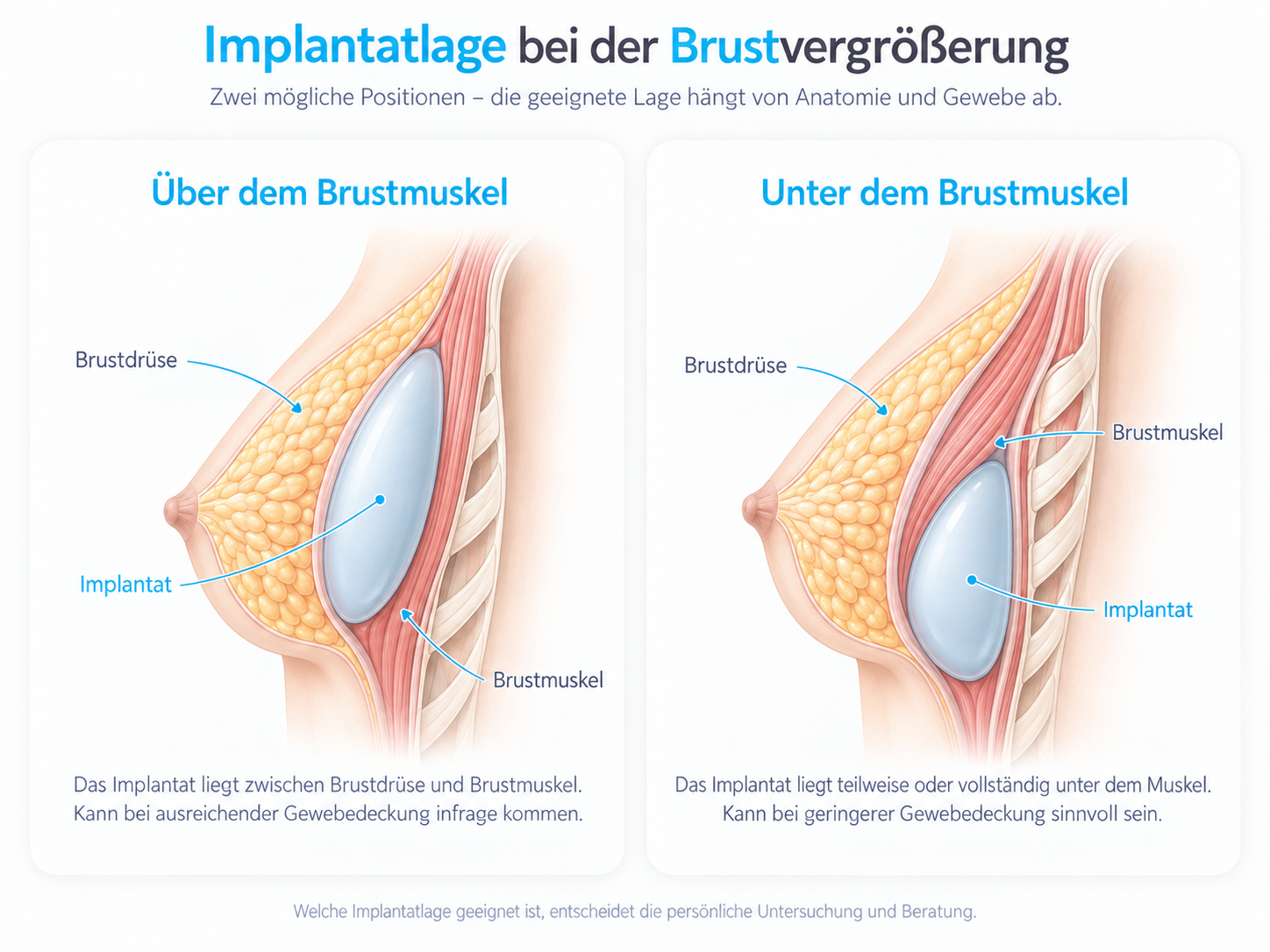 Querschnitt zur Implantatlage bei der Brustvergrößerung: Brustimplantat über oder unter dem Brustmuskel.