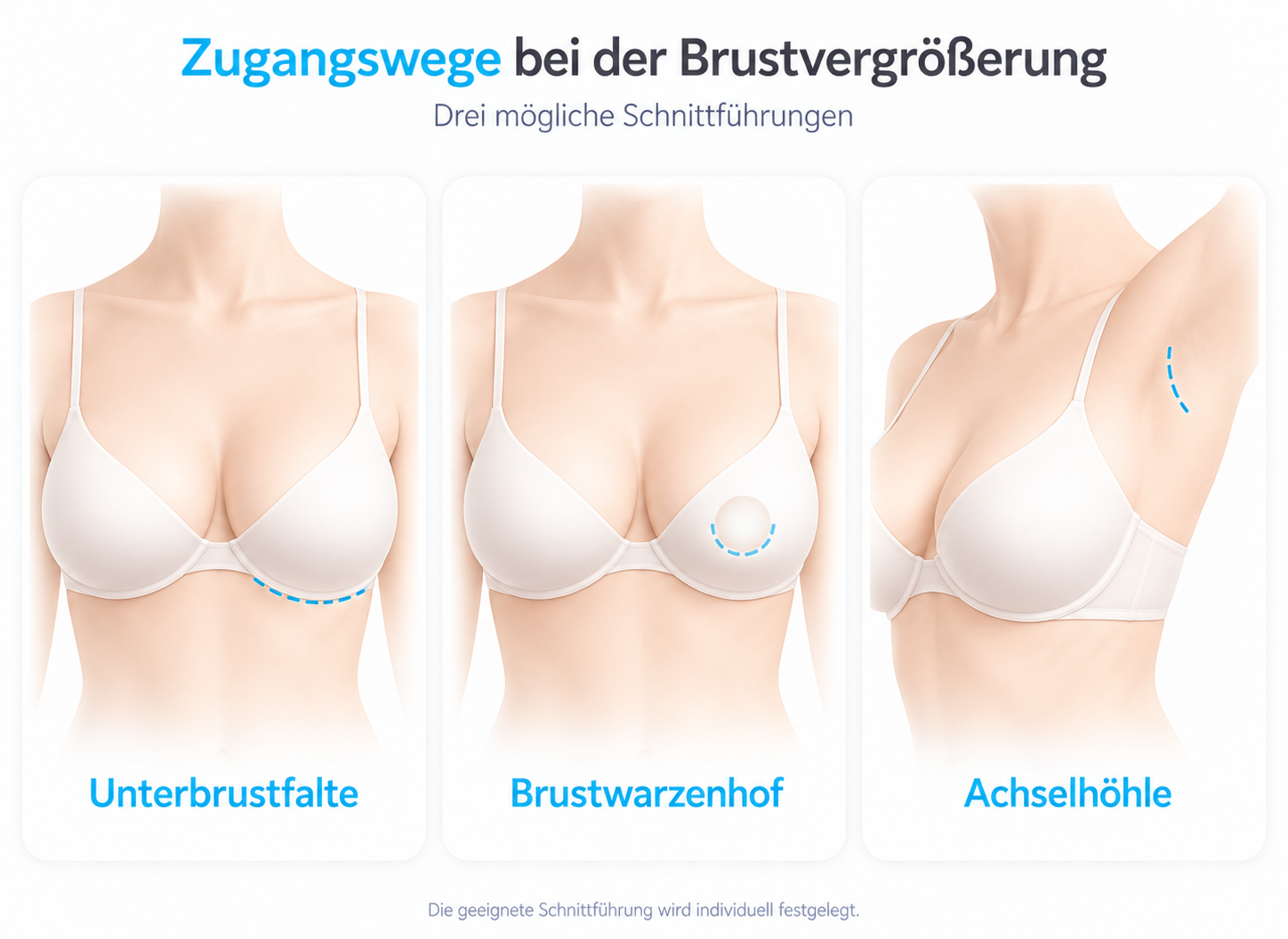 Drei Zugangswege bei der Brustvergrößerung: Schnitt in der Unterbrustfalte, am Brustwarzenhof oder in der Achselhöhle.