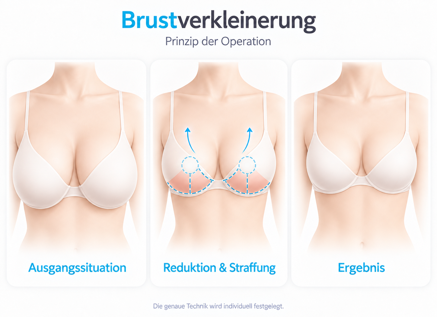 Schematische Darstellung einer Brustverkleinerung: Ausgangssituation, Reduktion mit Straffung und mögliche Ergebnisform.