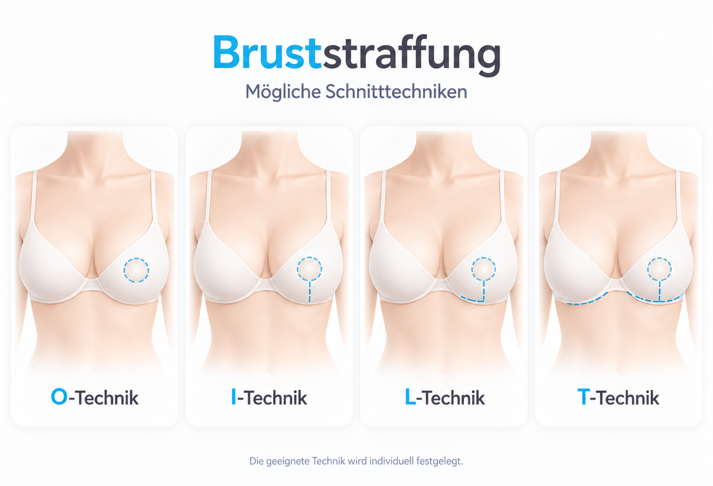Schematische Schnittführungen bei der Bruststraffung: O-Technik, I-Technik, L-Technik und T-Technik.
