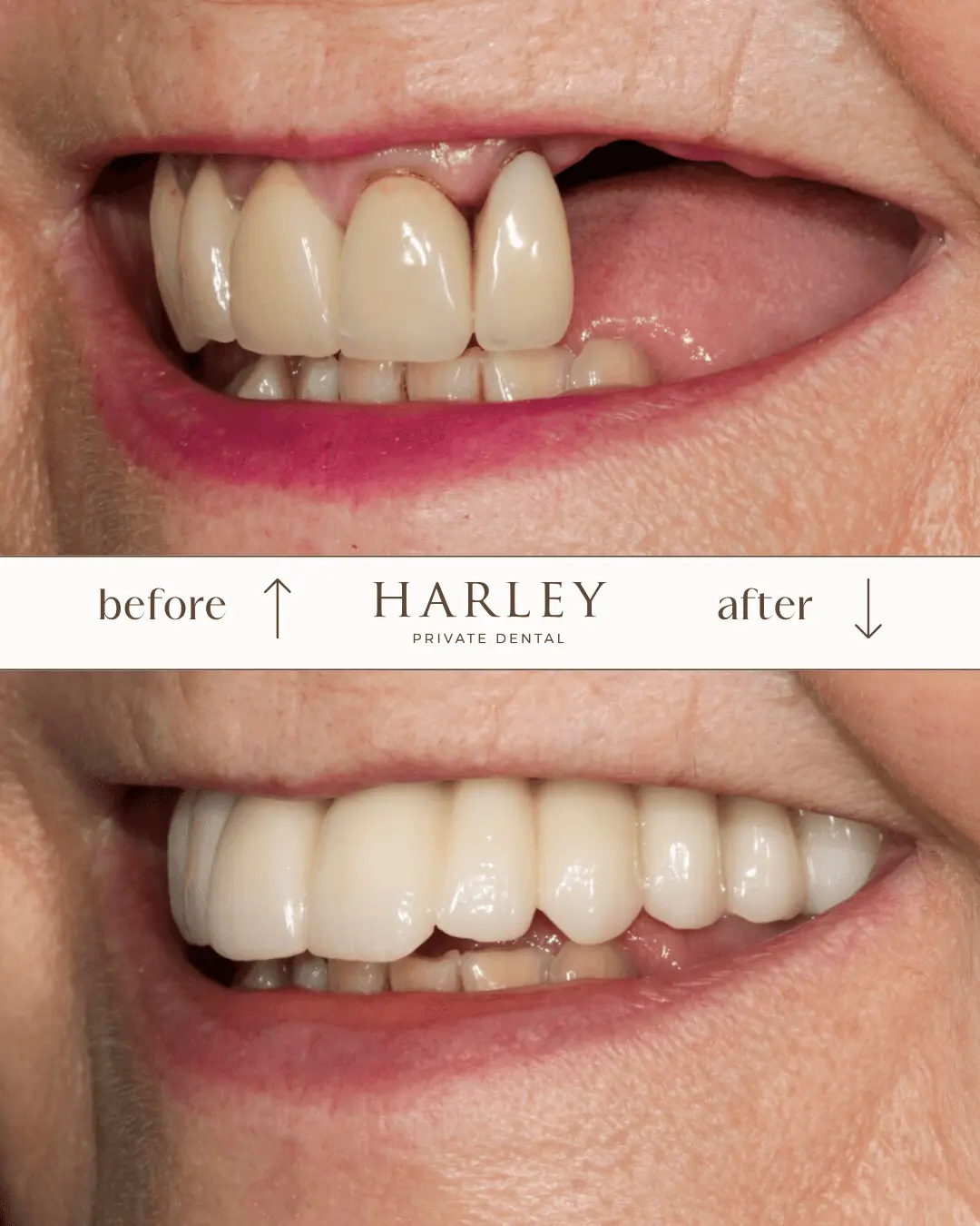 Close-up comparison of a smile before and after dental restoration showing missing and uneven teeth before and full, even, white teeth after.