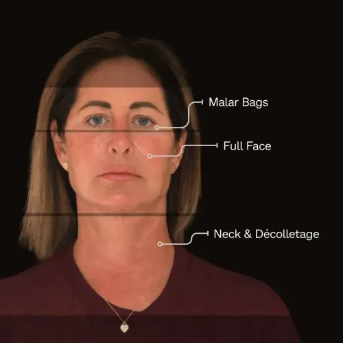 Endolifting Laser treatment areas