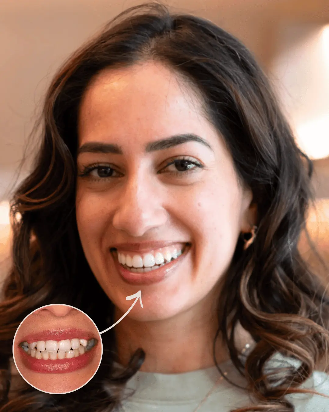 Before and after close-up of a smile showing dental improvement with whiter, even teeth after treatment.