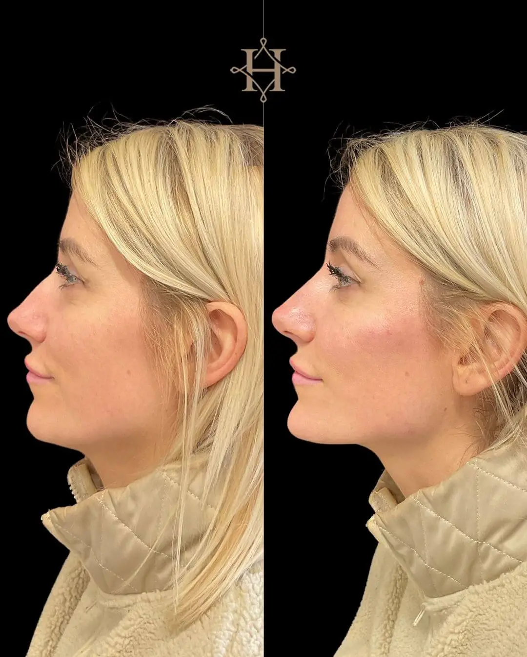 dermal fillers
