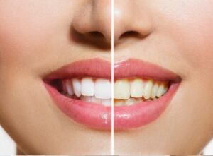 Why Are My Teeth Discoloured? How To Get a Whiter Smile