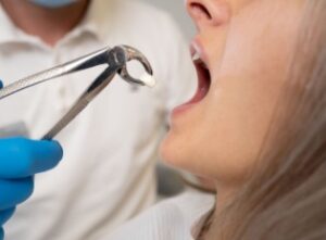 Dental Extraction: Why and How We Remove Teeth