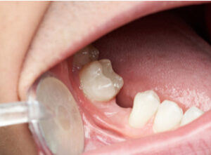 What Are the Options for Missing Teeth?