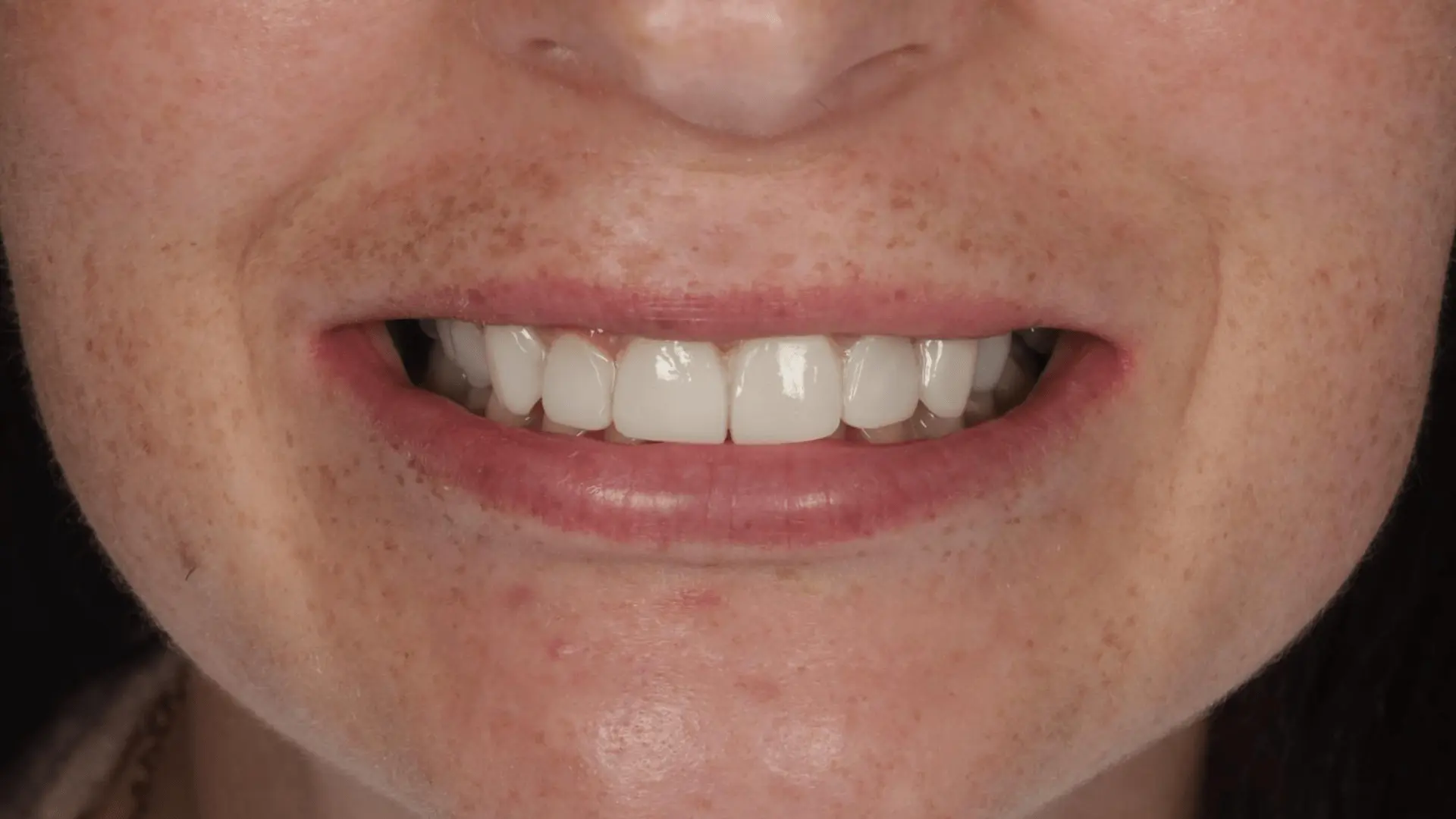 Professional Teeth Whitening in Sheffield: Why Enlighten Whitening Is Worth It