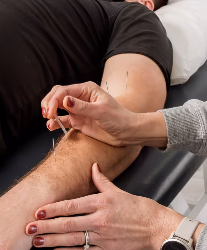 physiotherapist's hand using an acupuncture needle on a patient's arm