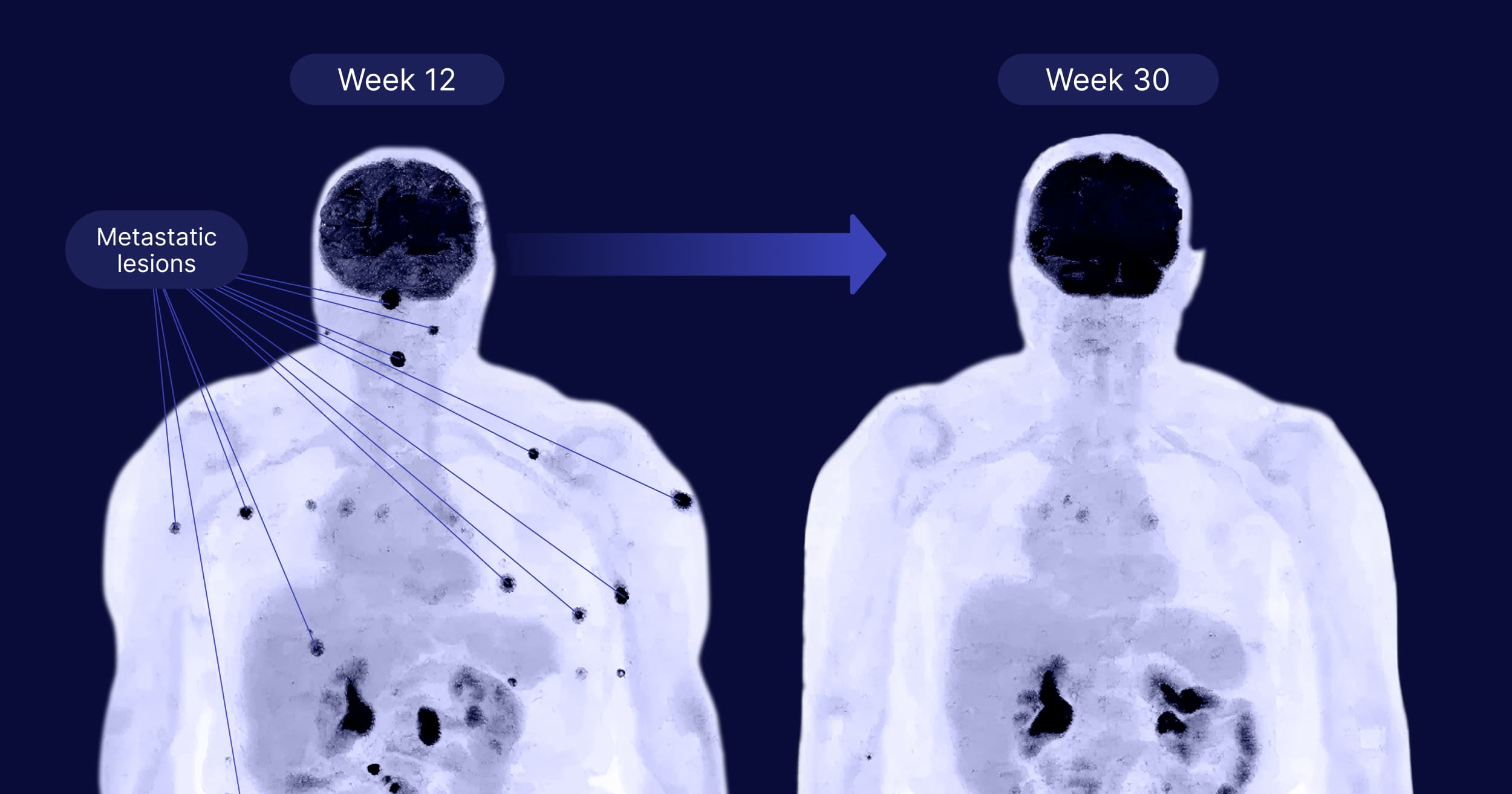 Two body scan images showing metastatic lesions at week 12 on the left image, with marked black spots, and a near-clear scan at week 30 on the right.