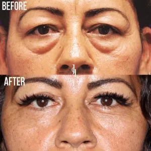 "eyelid-lift-pre-and-post-2"