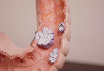 Close-up of a medical model showing the inside of the colon with polyps and abnormal growths.