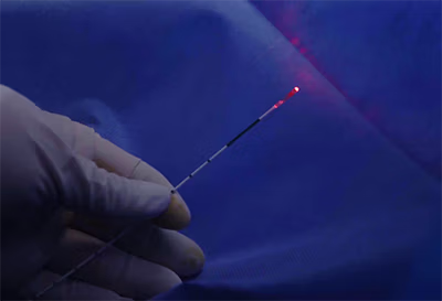 Hand wearing glove holding a thin medical laser fiber emitting red light.