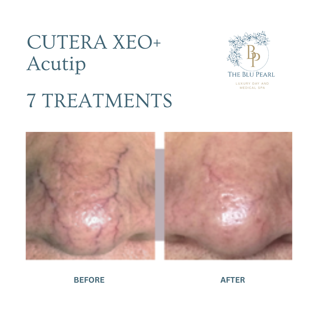 Before and after images of a nose showing reduced visible veins after 7 Cutera Xeo+ Acutip treatments.