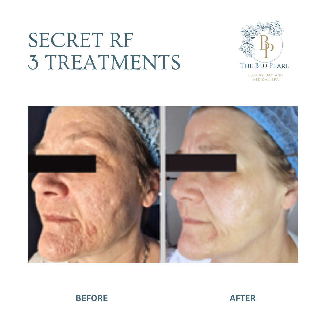 Side-by-side before and after photos showing reduced facial skin wrinkles and smoother texture after three RF treatments.